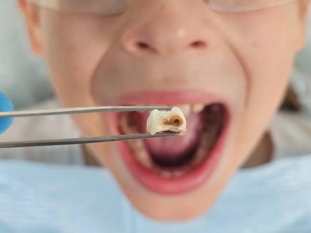 Best Emergency Root Canal Treatment in Lauderdale Lakes, WI